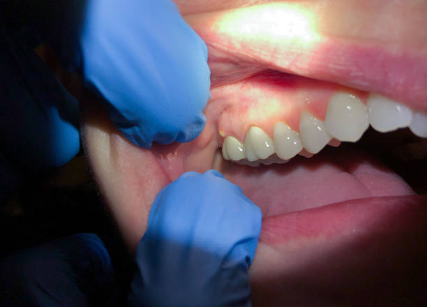 Best Emergency Treatment for Toothache in Lame Deer, MT