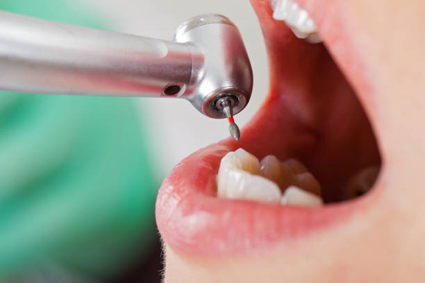 Best Emergency Broken Tooth Repair in Lame Deer, MT